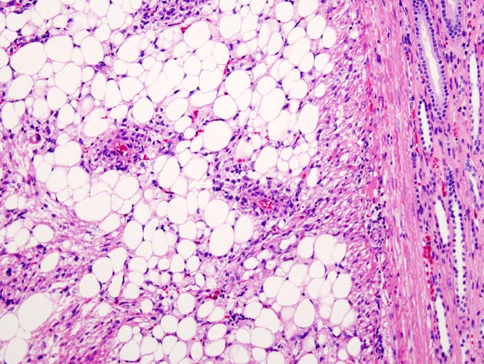 Histopathologic image of renal angiomyolipoma nephrectomy sp