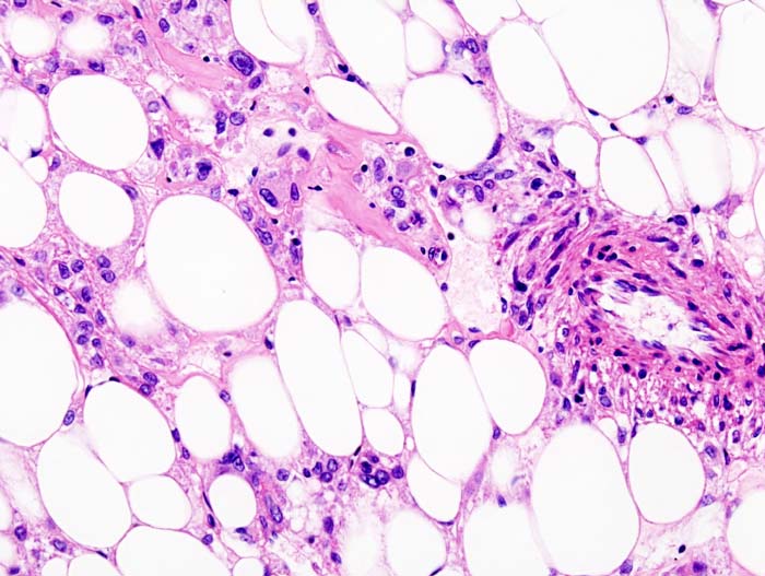 Histopathologic image of renal angiomyolipoma nephrectomy sp