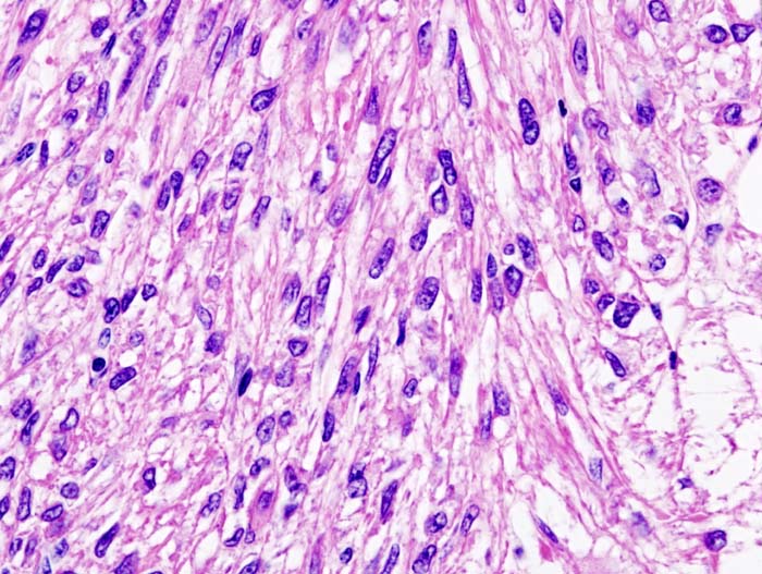 Histopathologic image of renal angiomyolipoma nephrectomy sp