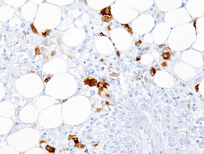 Histopathologic image of renal angiomyolipoma nephrectomy sp
