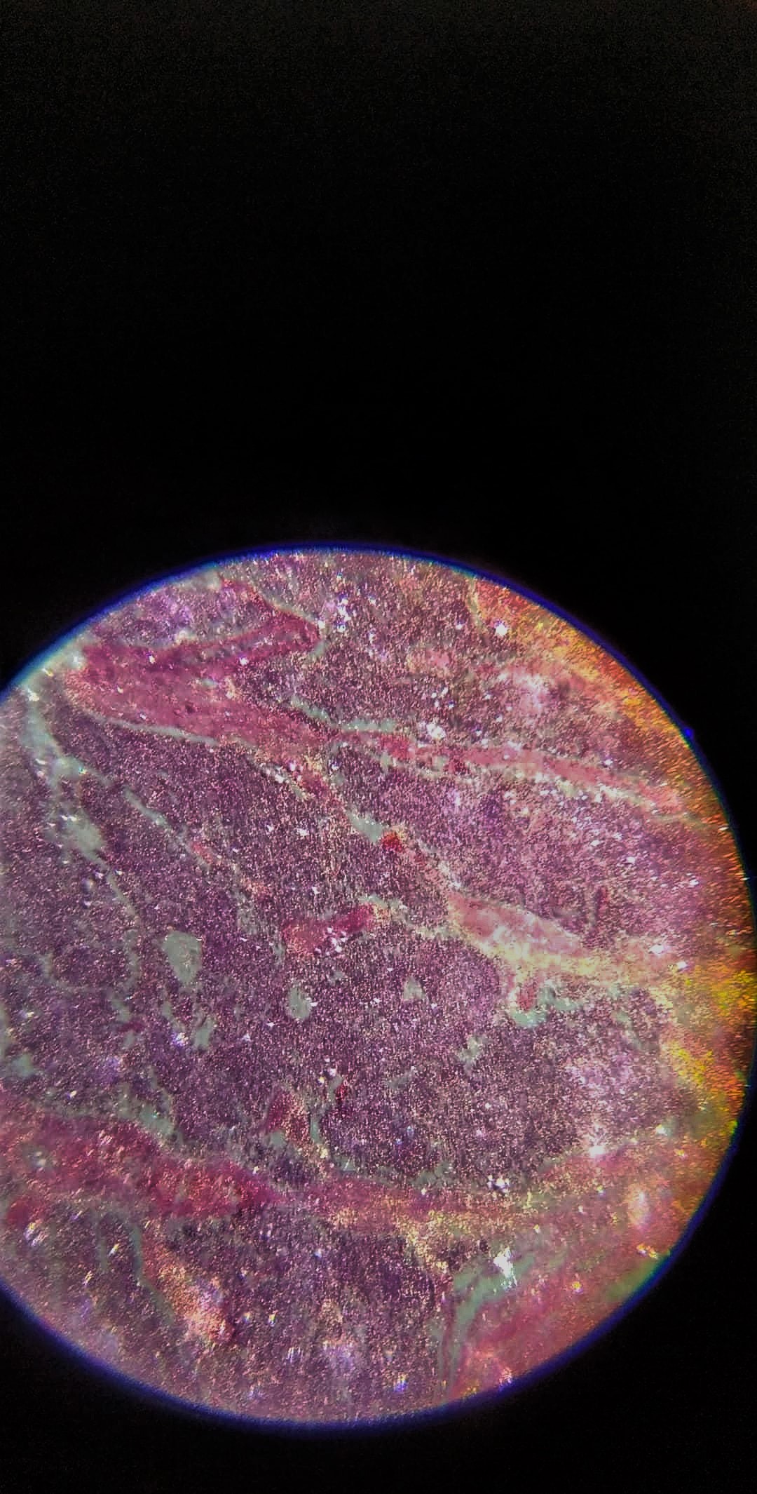 Microscopic image of testicular cancer