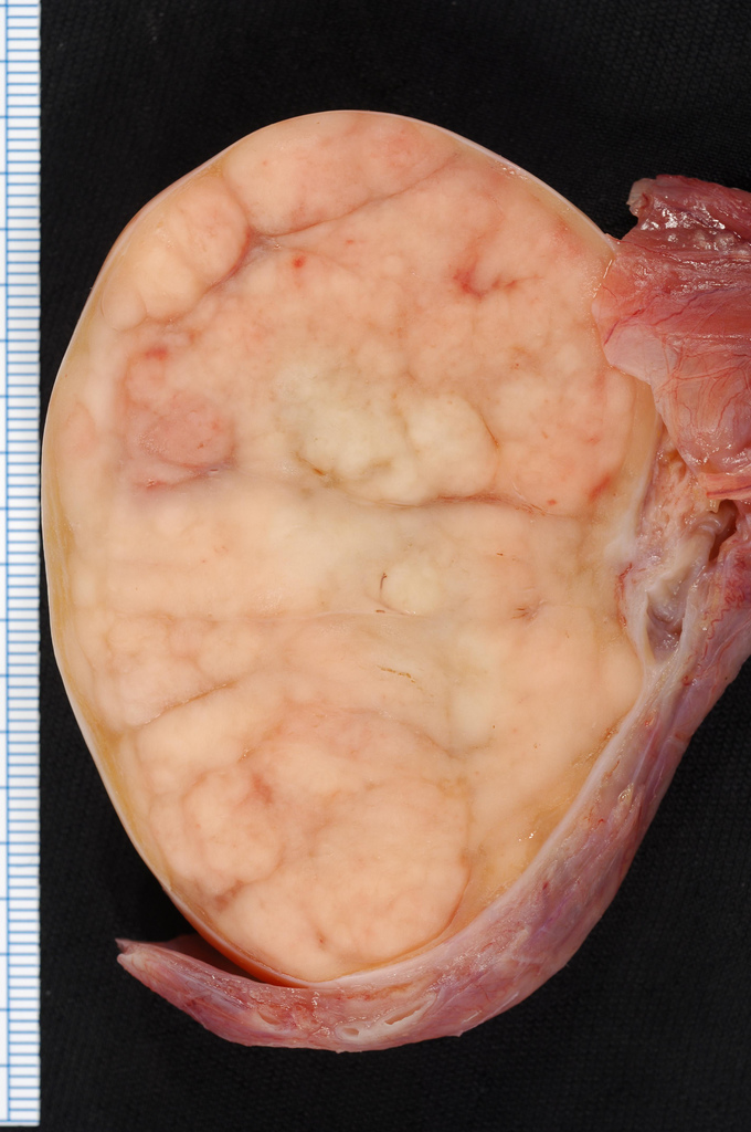Seminoma of the testis