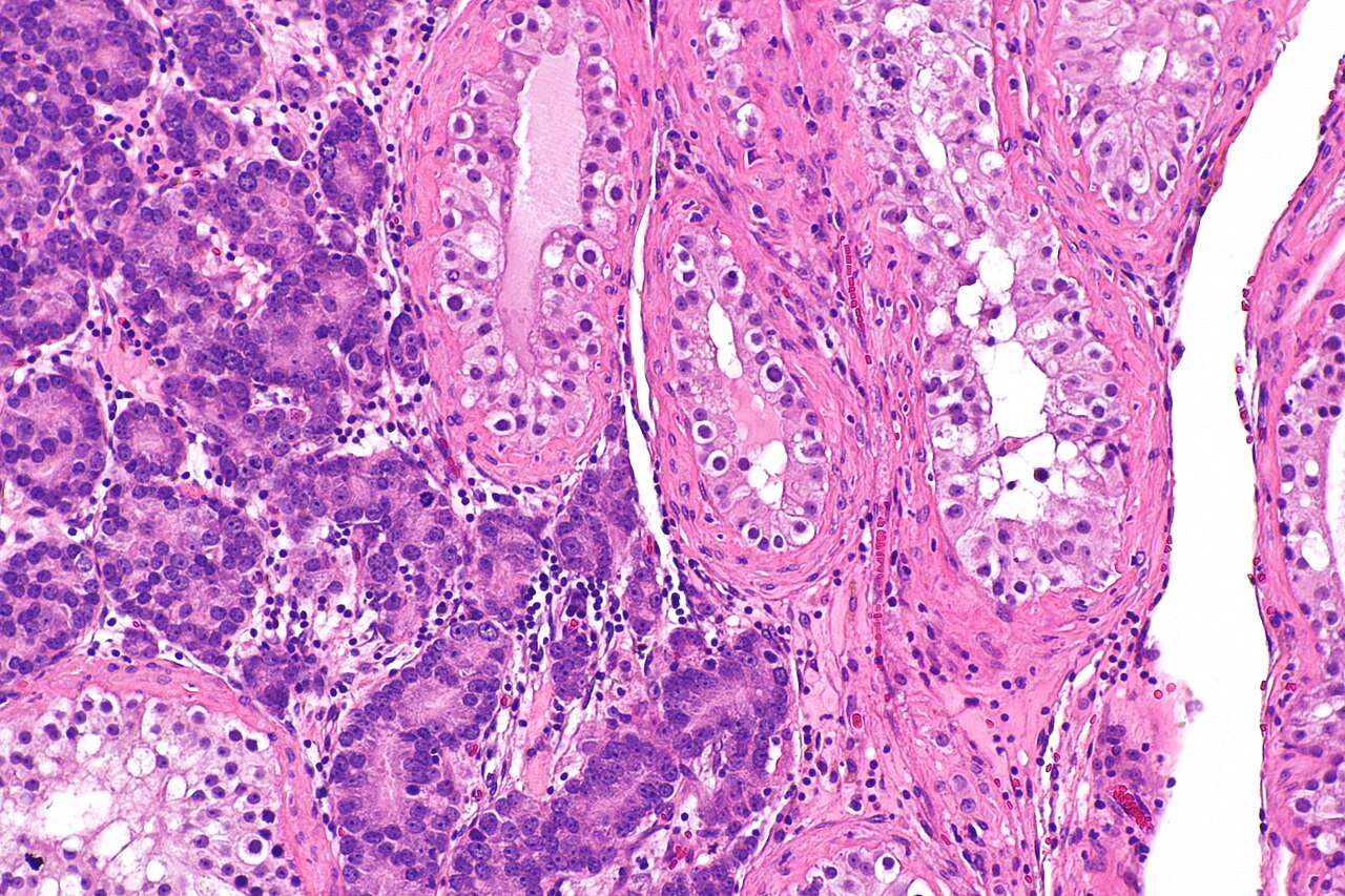 Micrograph showing testis with metastatic prostate carcinoma