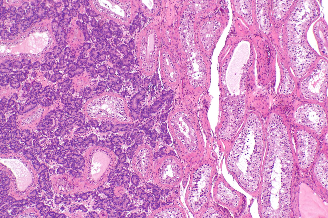 Micrograph showing testis with metastatic prostate carcinoma