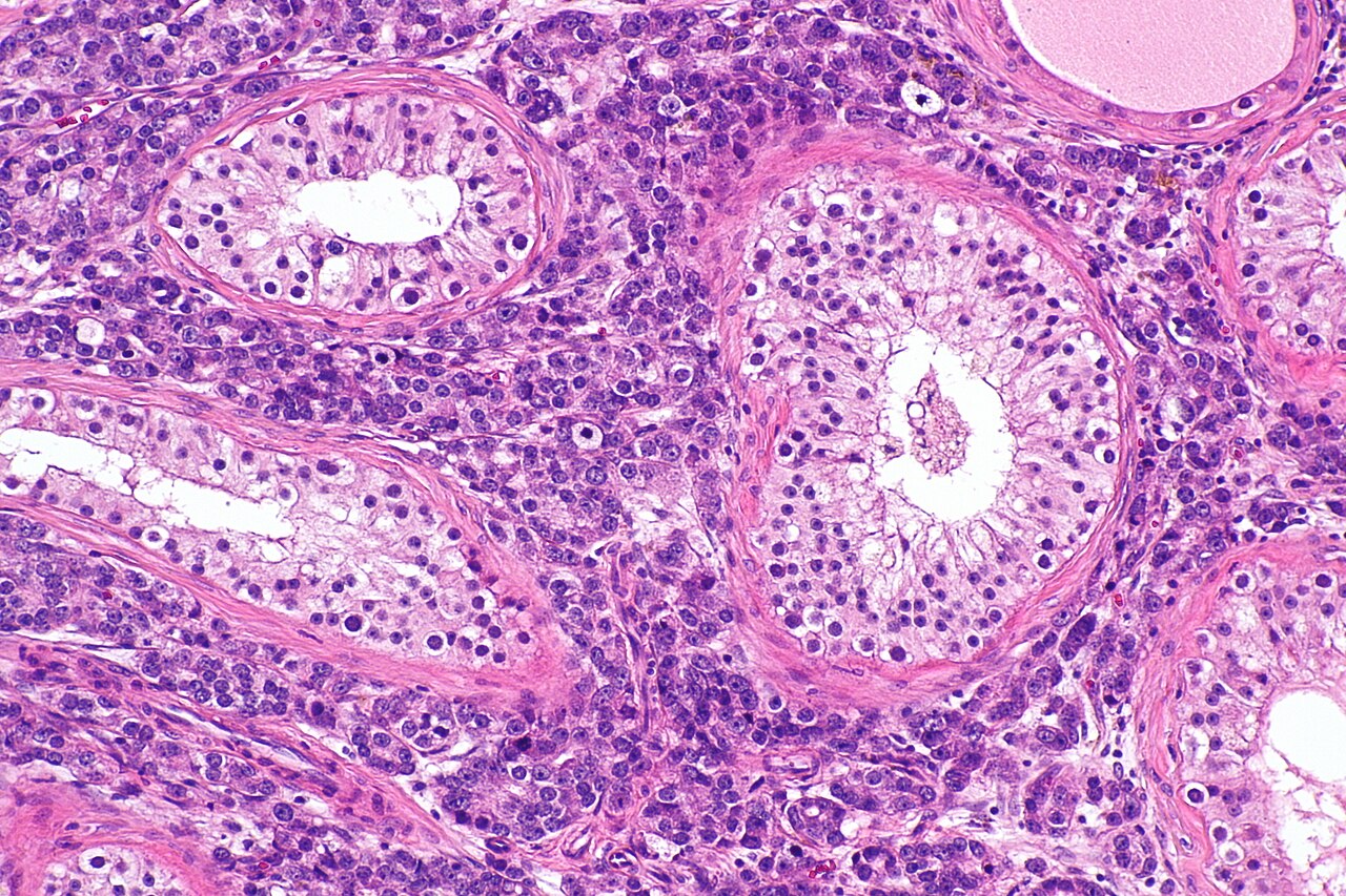 Micrograph showing testis with metastatic prostate carcinoma