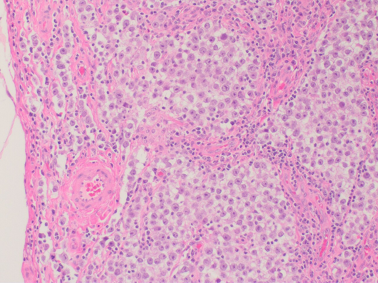 Histopathology of seminoma intermediate magnification h amp