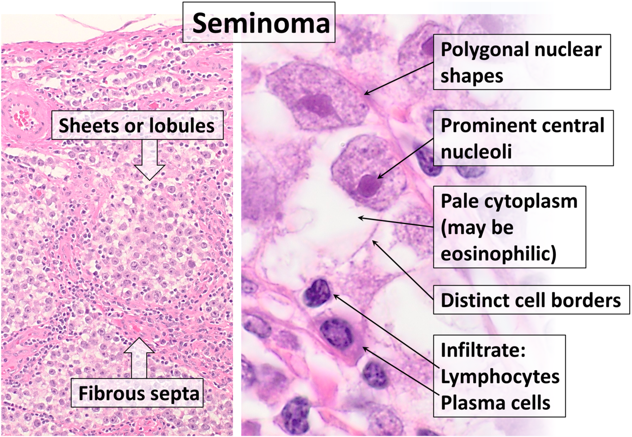 Histopathology of classical seminoma with typical features h