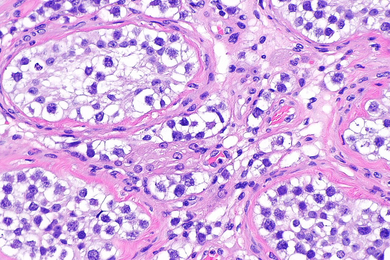 Micrograph showing an intertubular seminoma abbreviated its