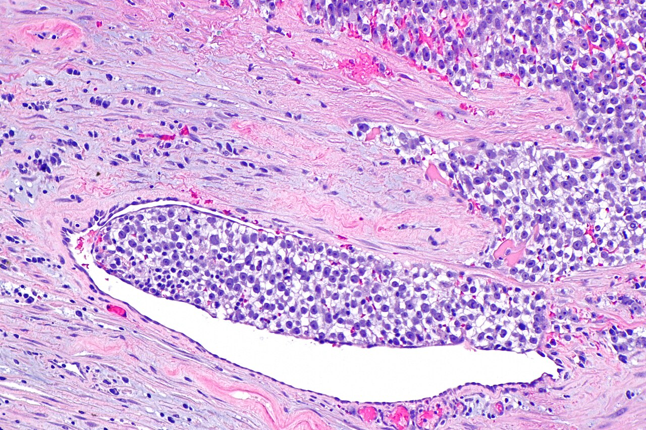 Micrograph showing a seminoma with syncytiotrophoblasts h am