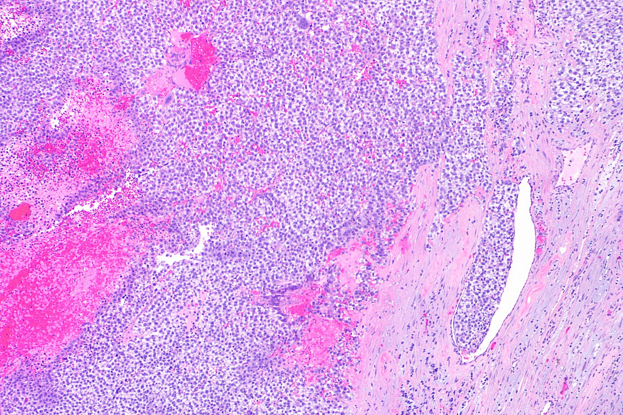 Micrograph showing a seminoma with syncytiotrophoblasts h am