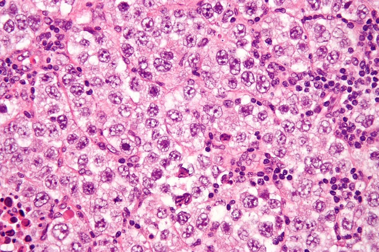 Micrograph of a seminoma h amp e stain features lymphocytes