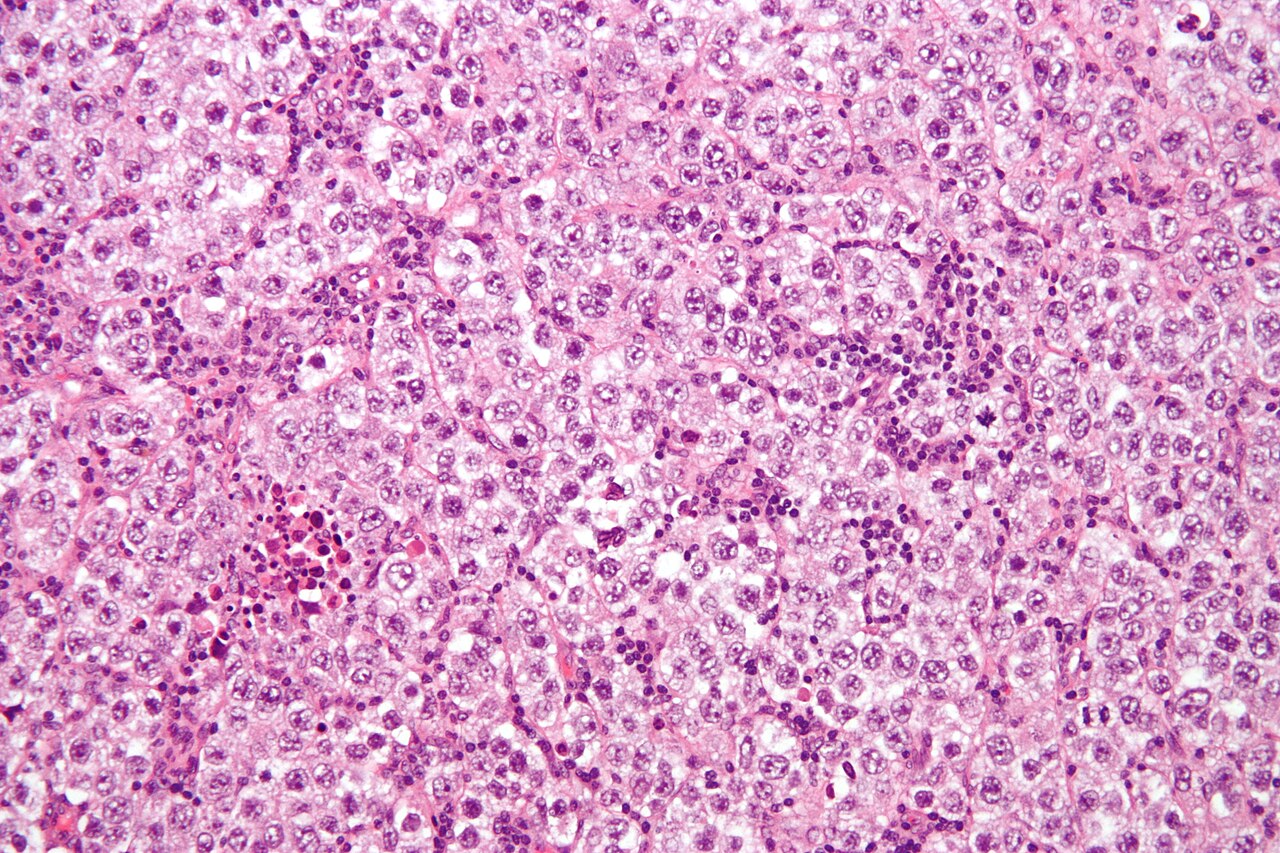 Micrograph of a seminoma h amp e stain features lymphocytes