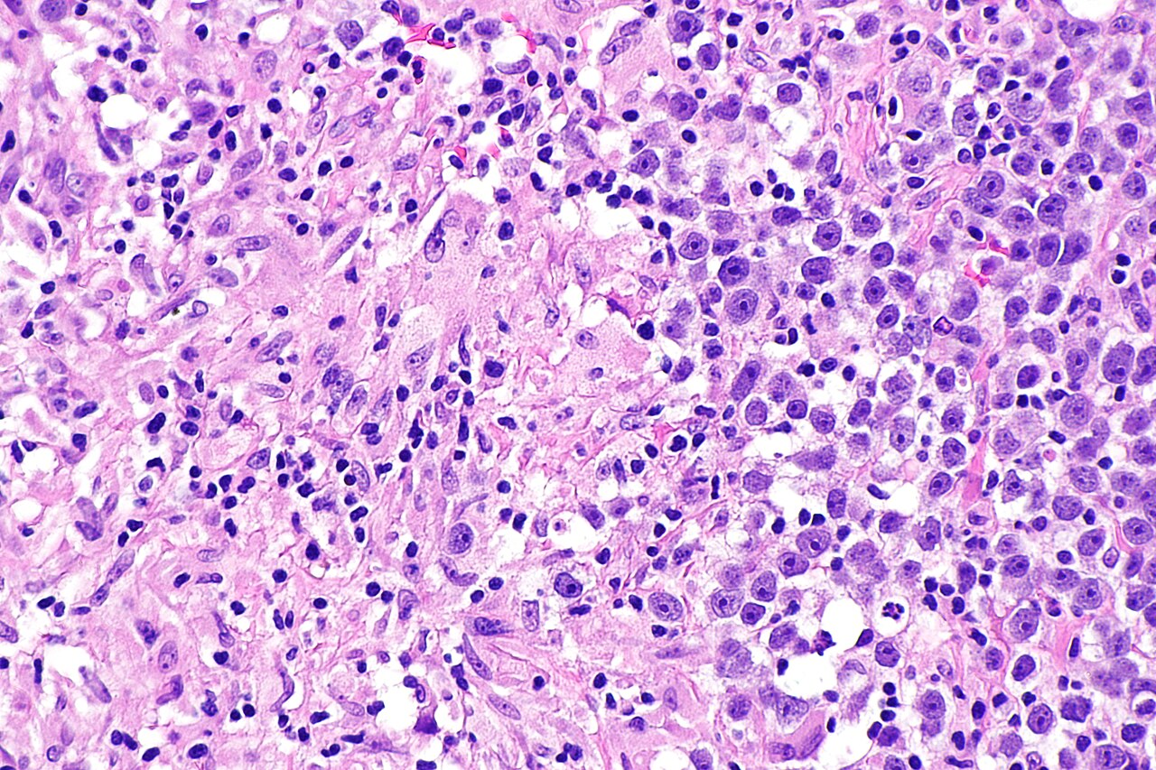 Micrograph showing a seminoma with granulomas h amp e stain