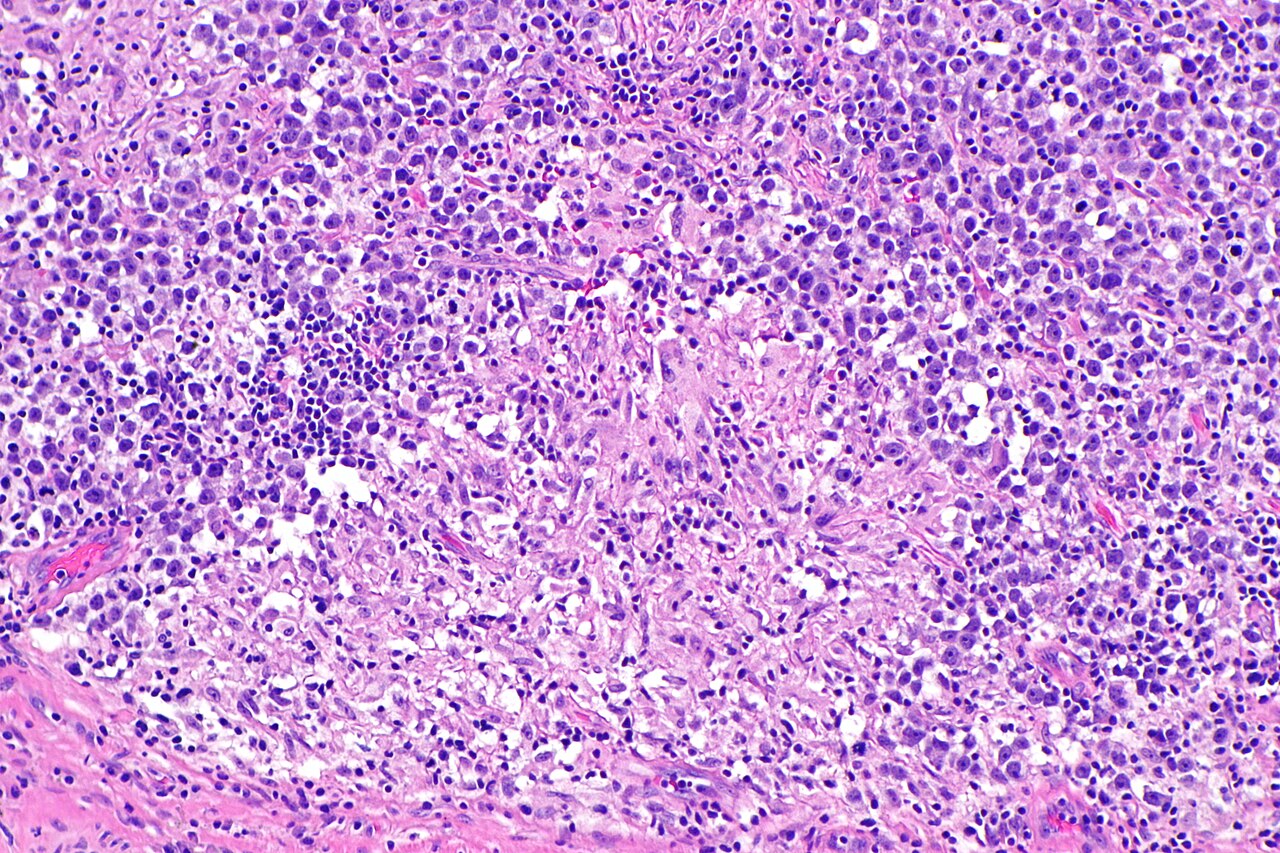Micrograph showing a seminoma with granulomas h amp e stain