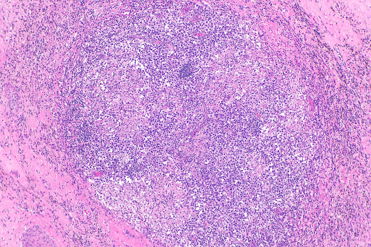 Micrograph showing a seminoma with granulomas h amp e stain