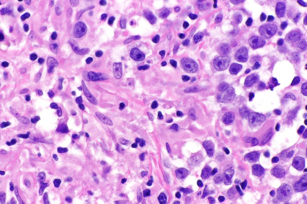 Micrograph showing a seminoma with granulomas h amp e stain