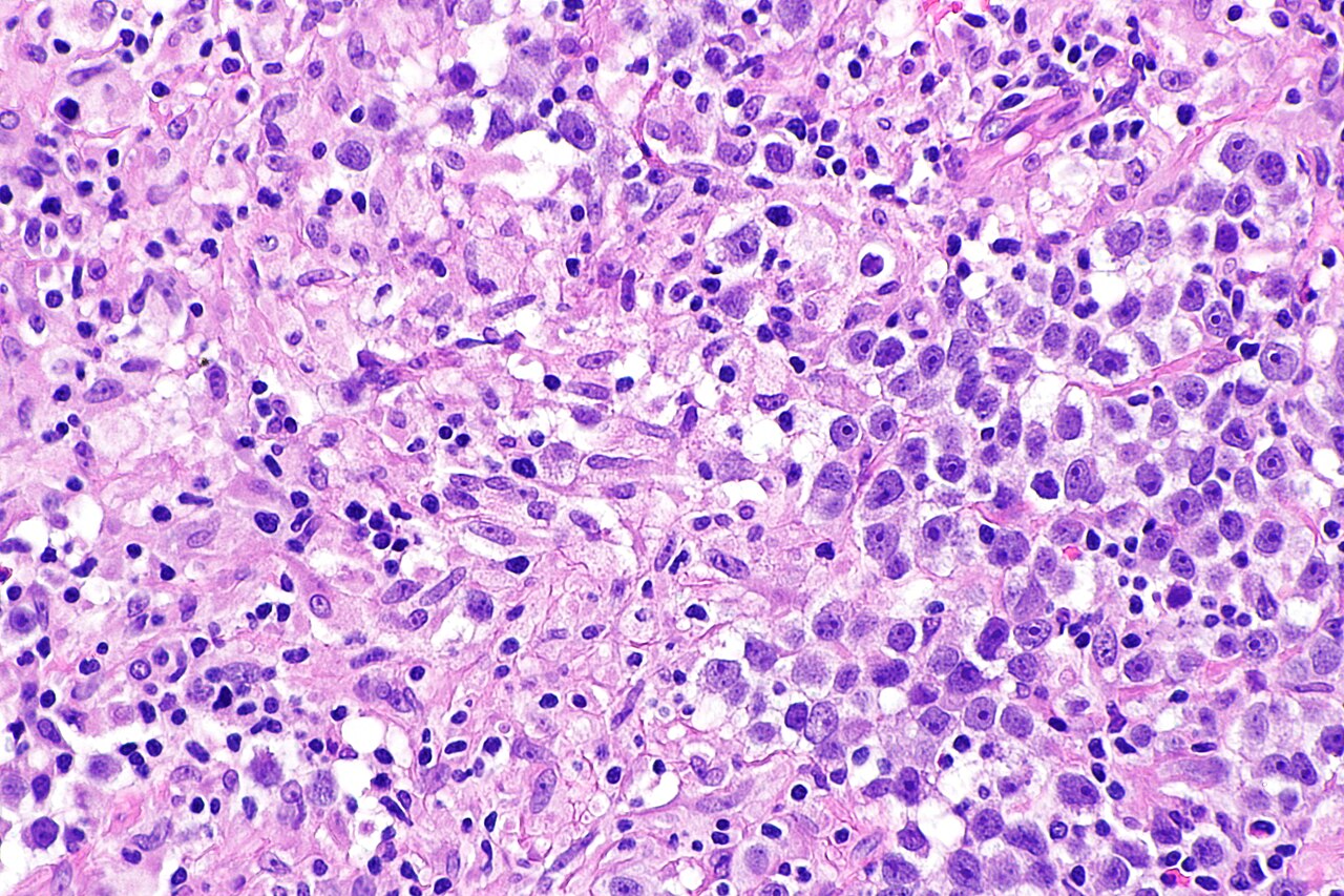 Micrograph showing a seminoma with granulomas h amp e stain