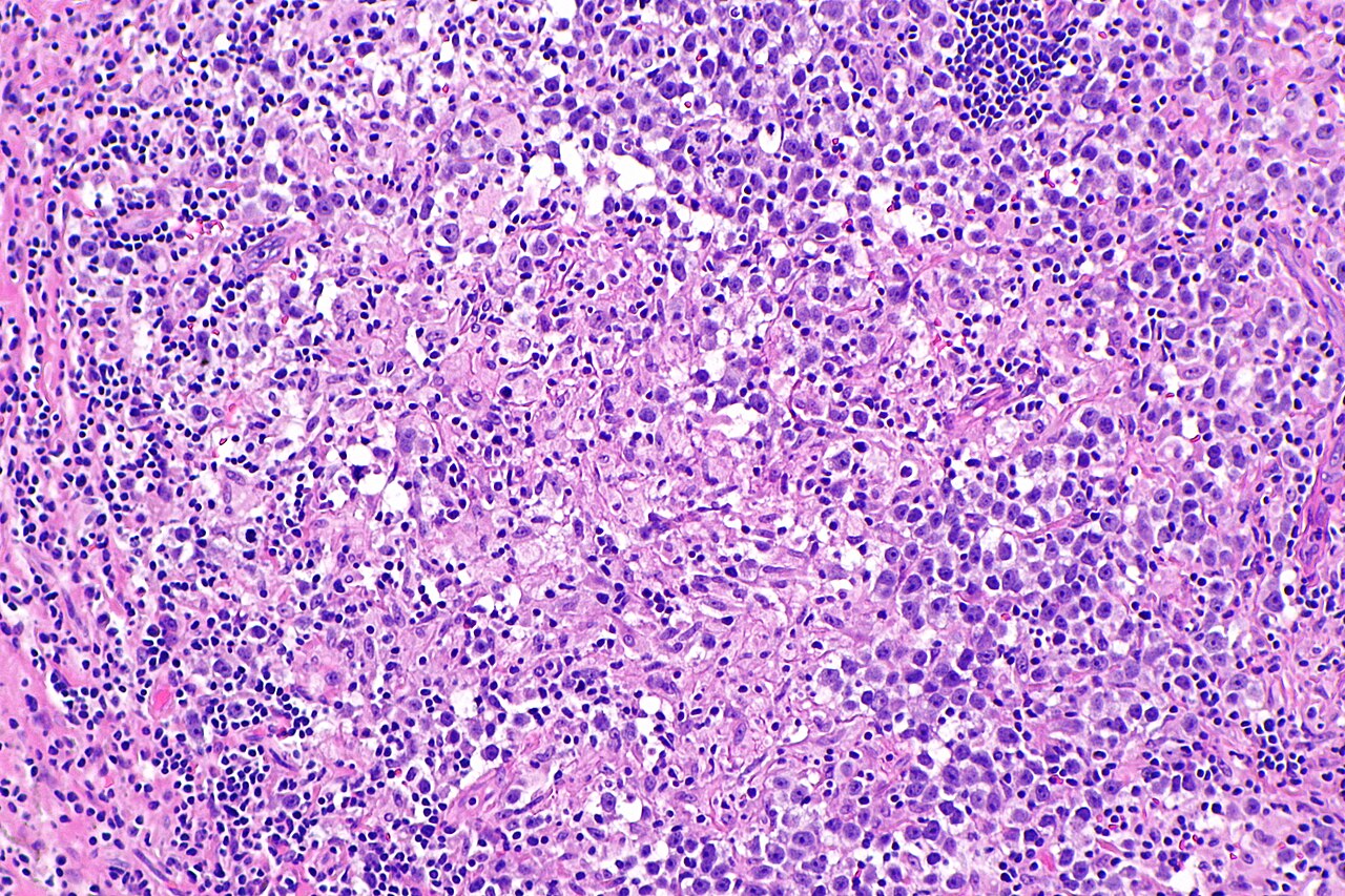 Micrograph showing a seminoma with granulomas h amp e stain