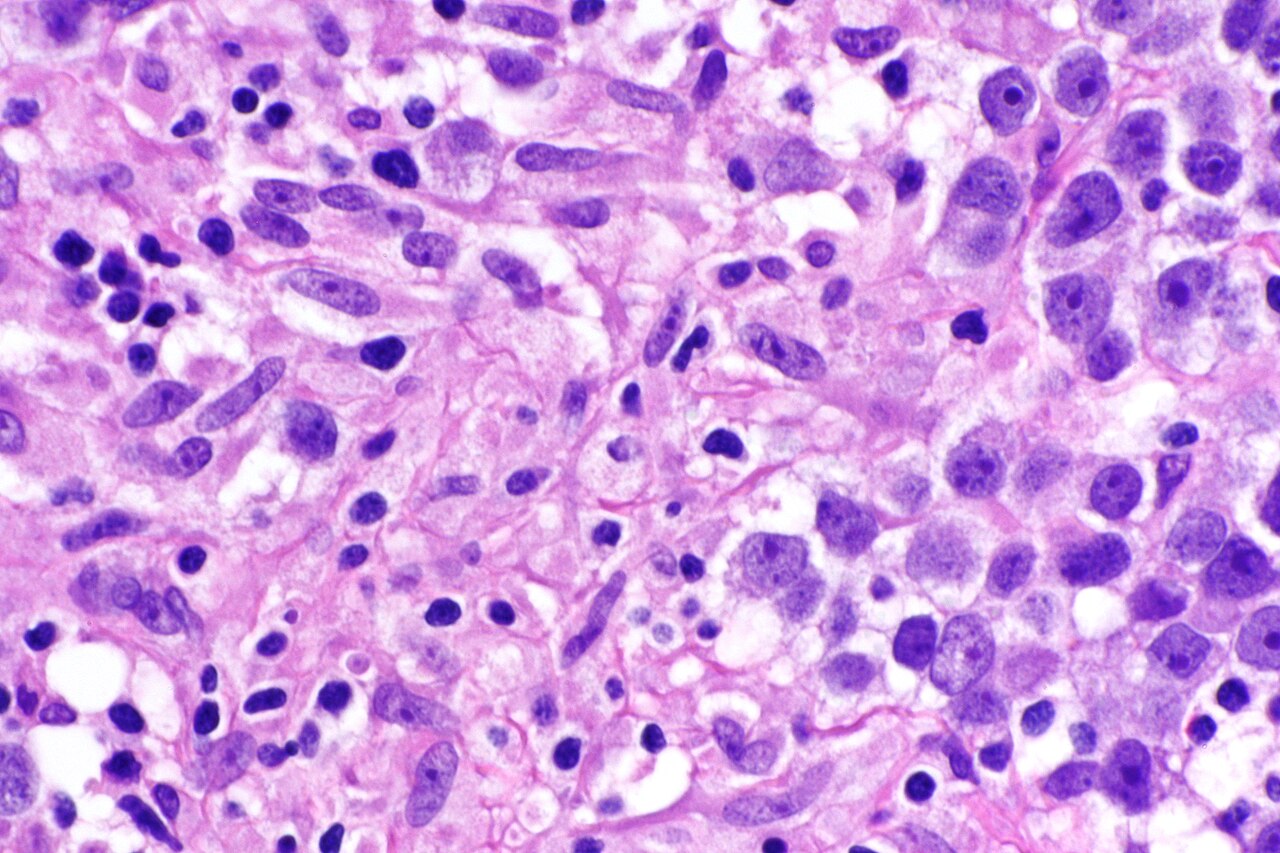 Micrograph showing a seminoma with granulomas h amp e stain