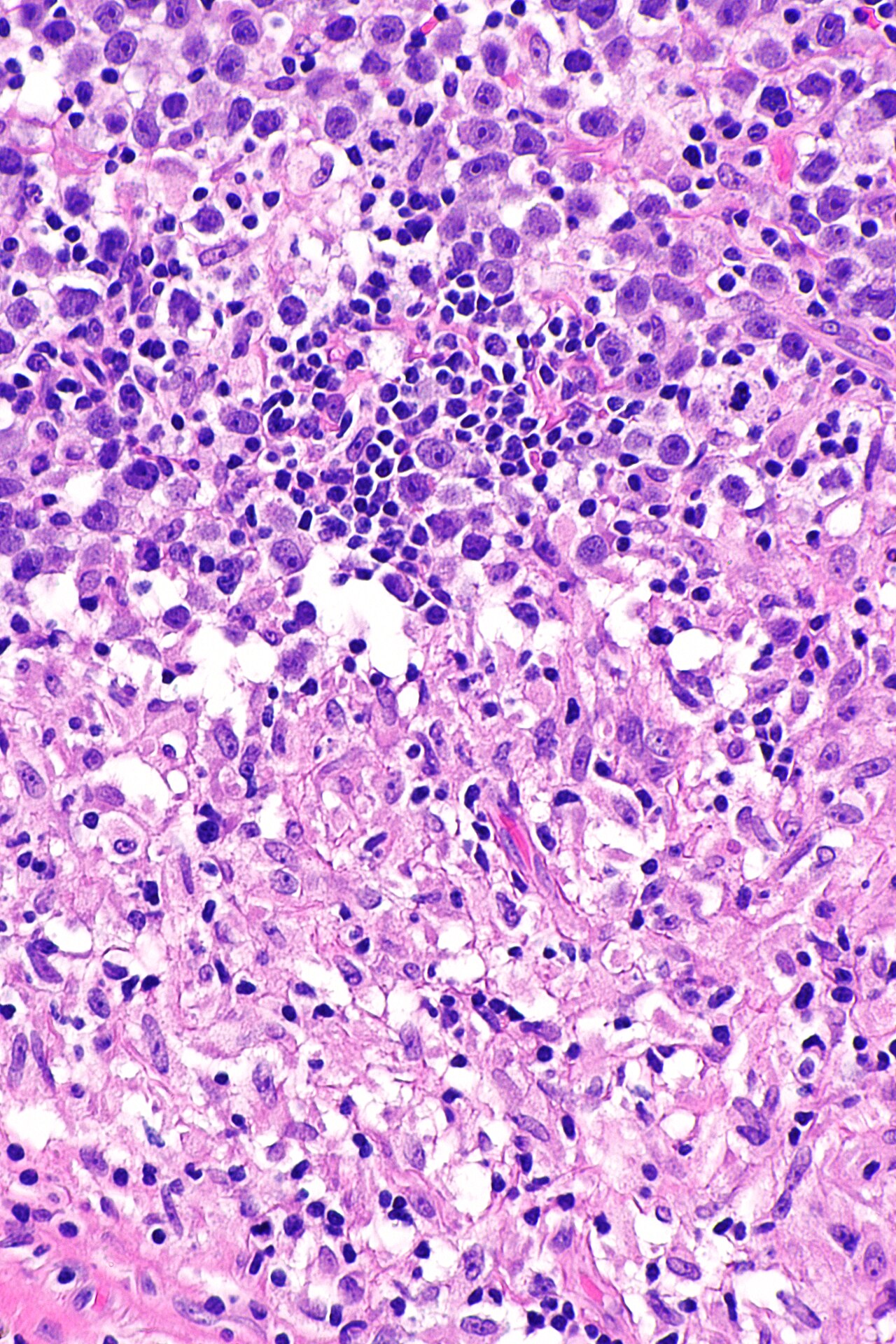 Micrograph showing a seminoma with granulomas h amp e stain