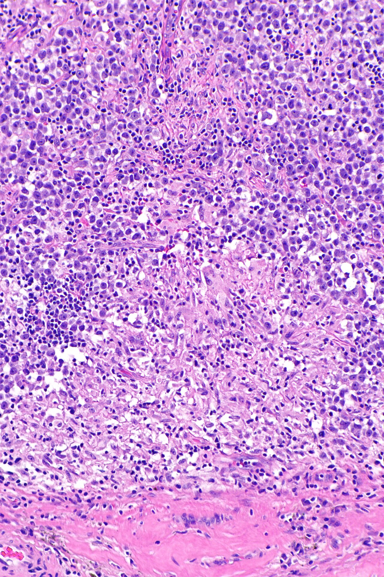 Micrograph showing a seminoma with granulomas h amp e stain