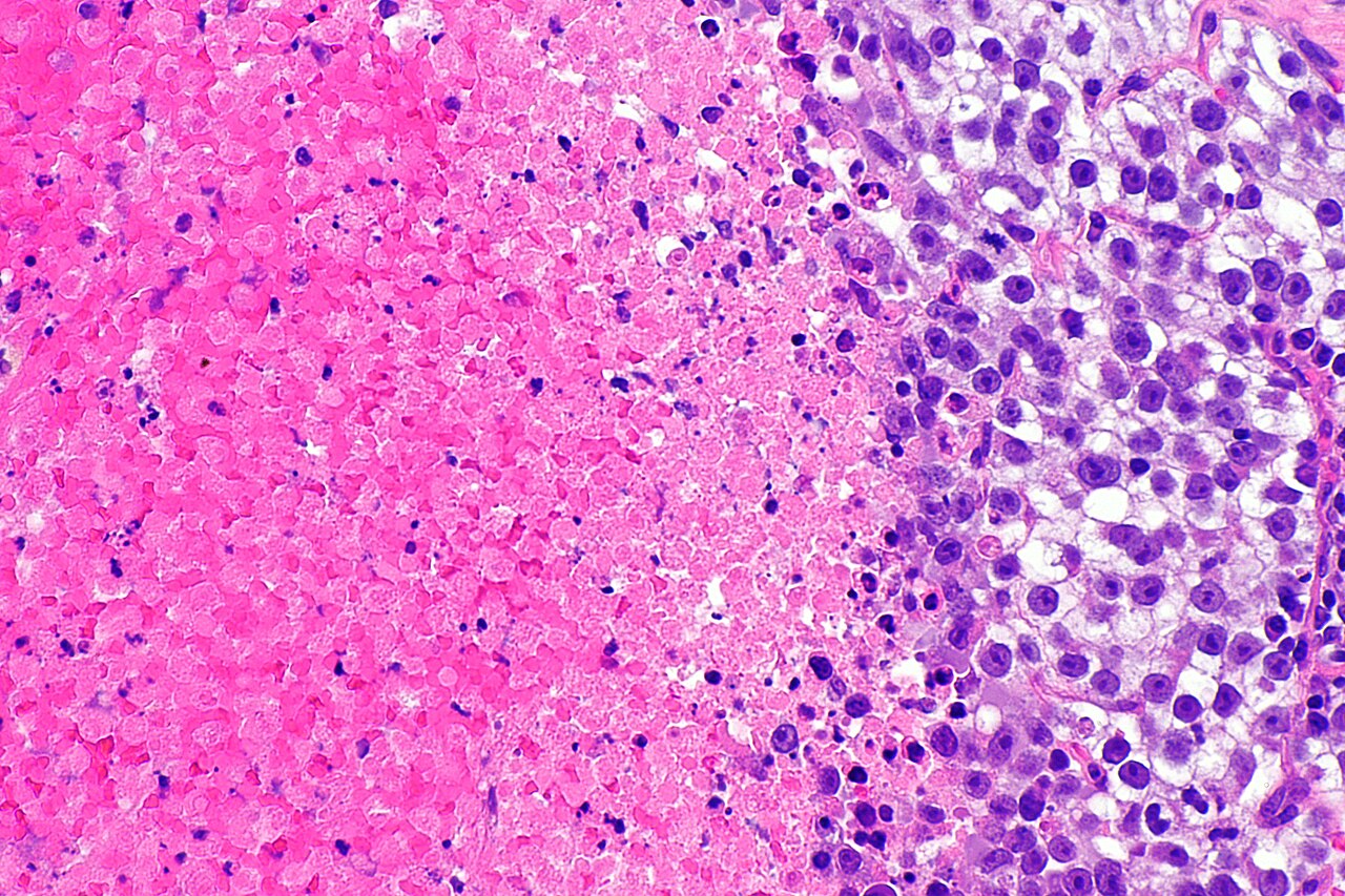 Micrograph showing a seminoma with syncytiotrophoblasts h am