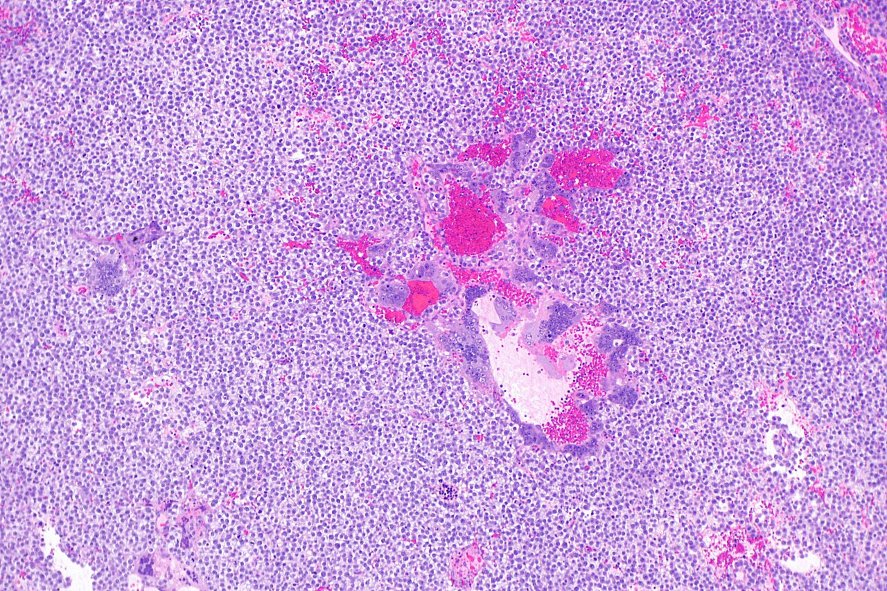 Micrograph showing a seminoma with syncytiotrophoblasts h am