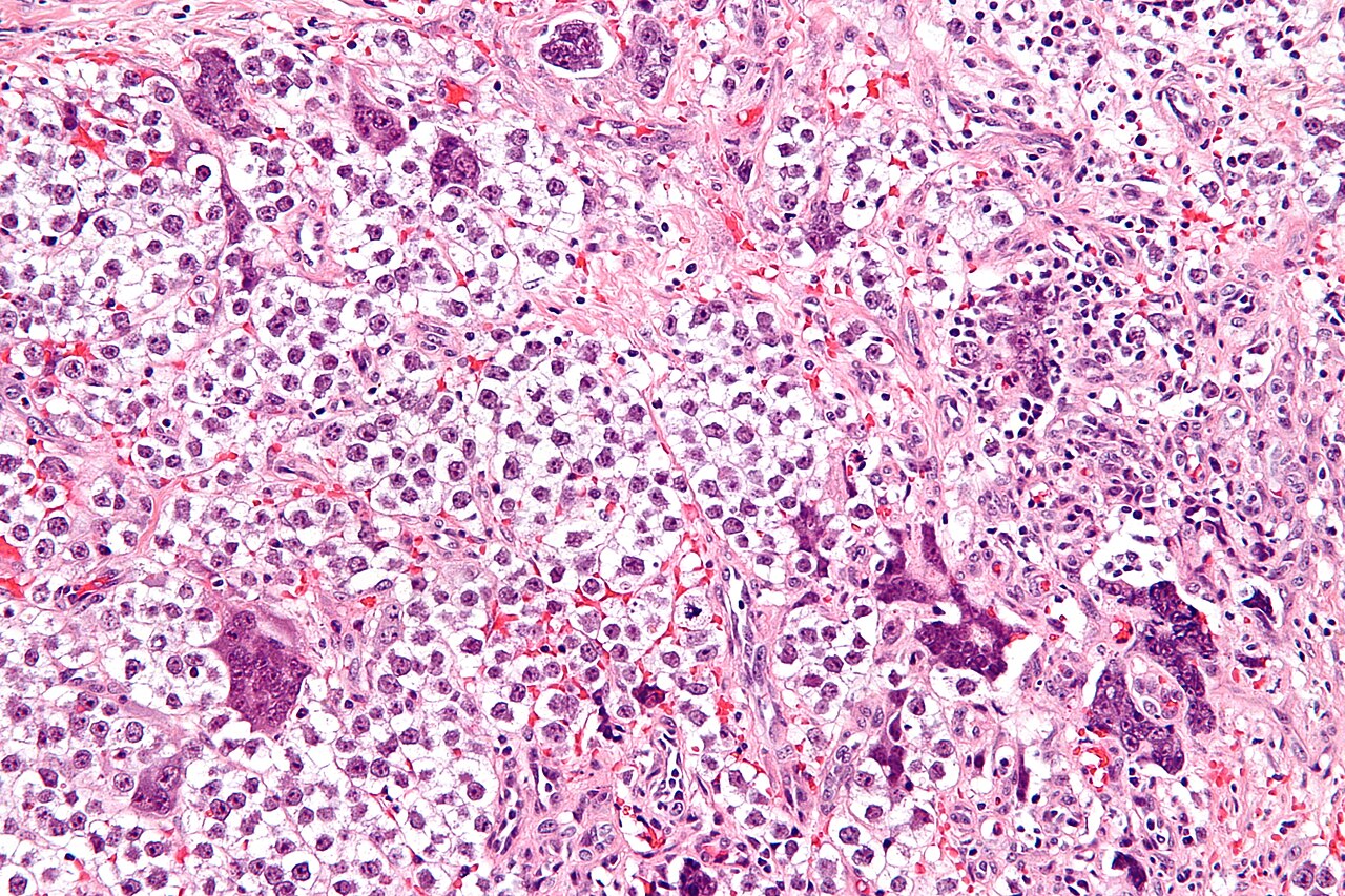 High magnification micrograph of a seminoma with syncytiotro