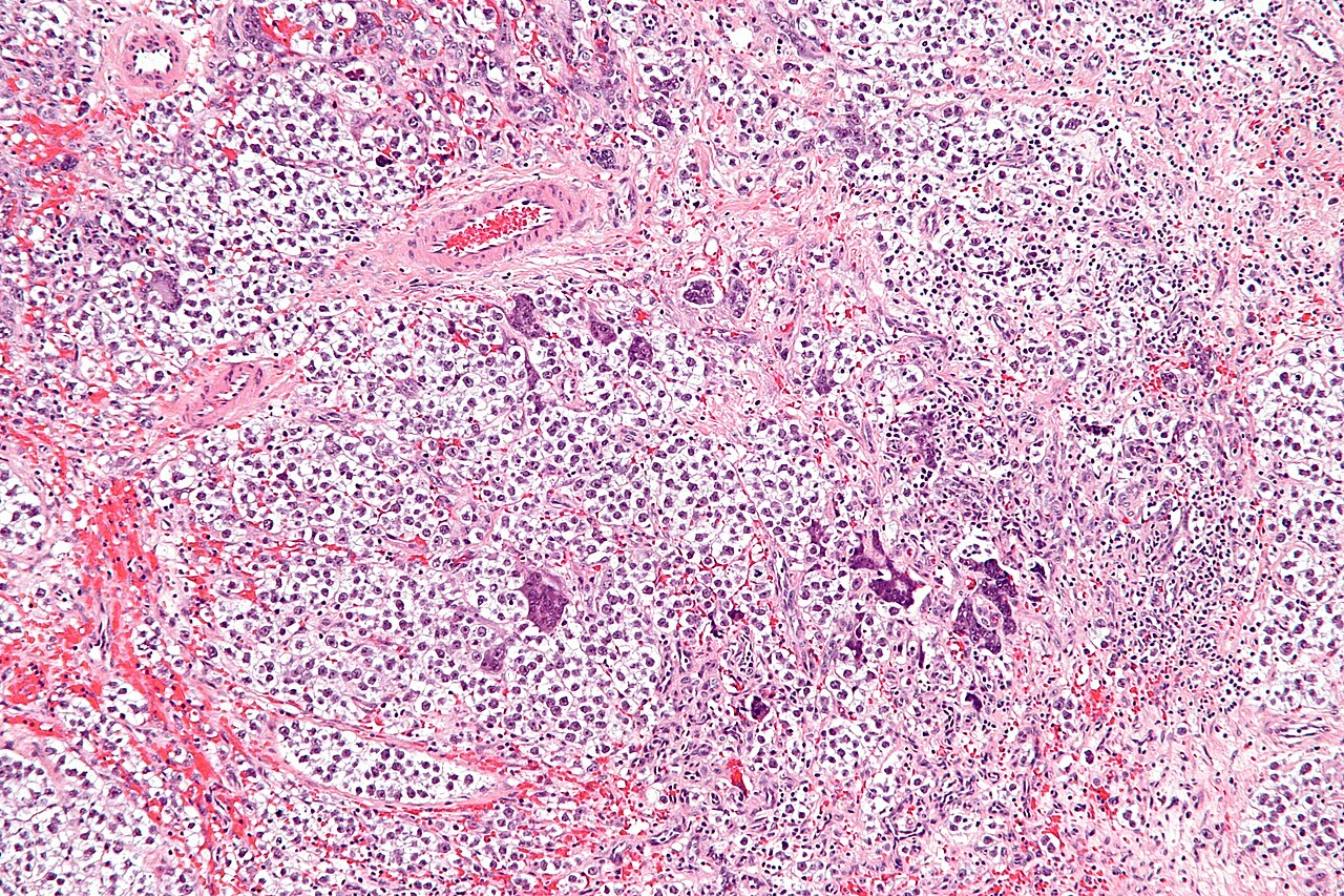 Intermediate magnification micrograph of a seminoma with syn