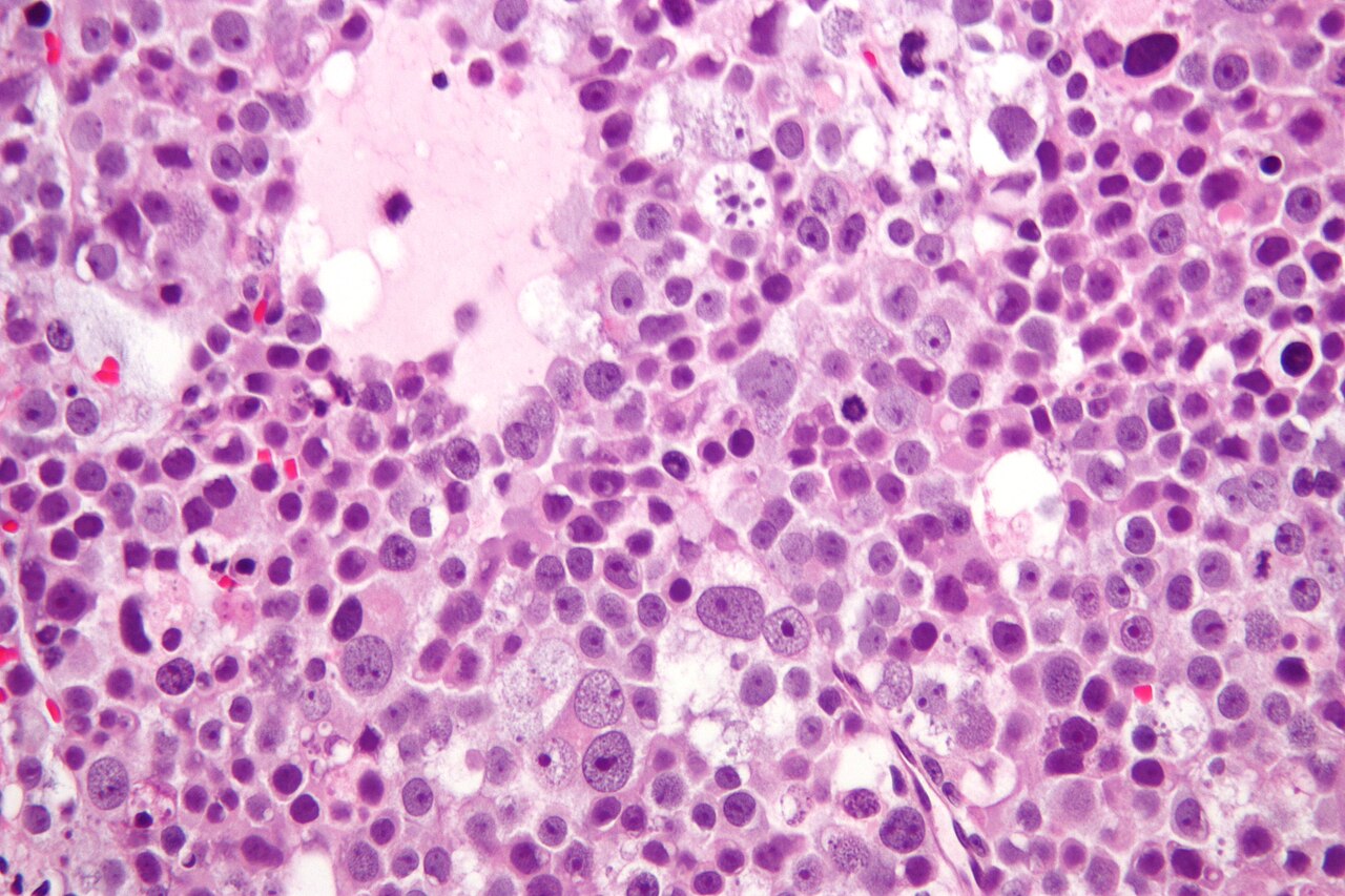 Micrograph of a spermatocytic seminoma h amp e stain feature