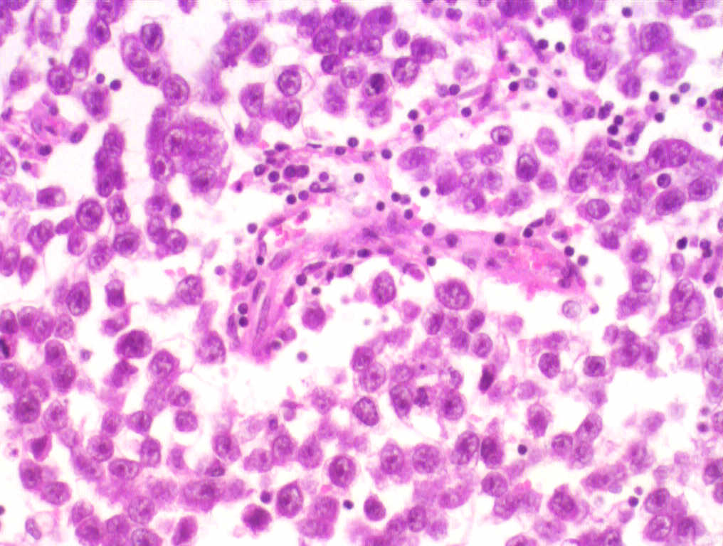 Testis seminoma h amp e 200x