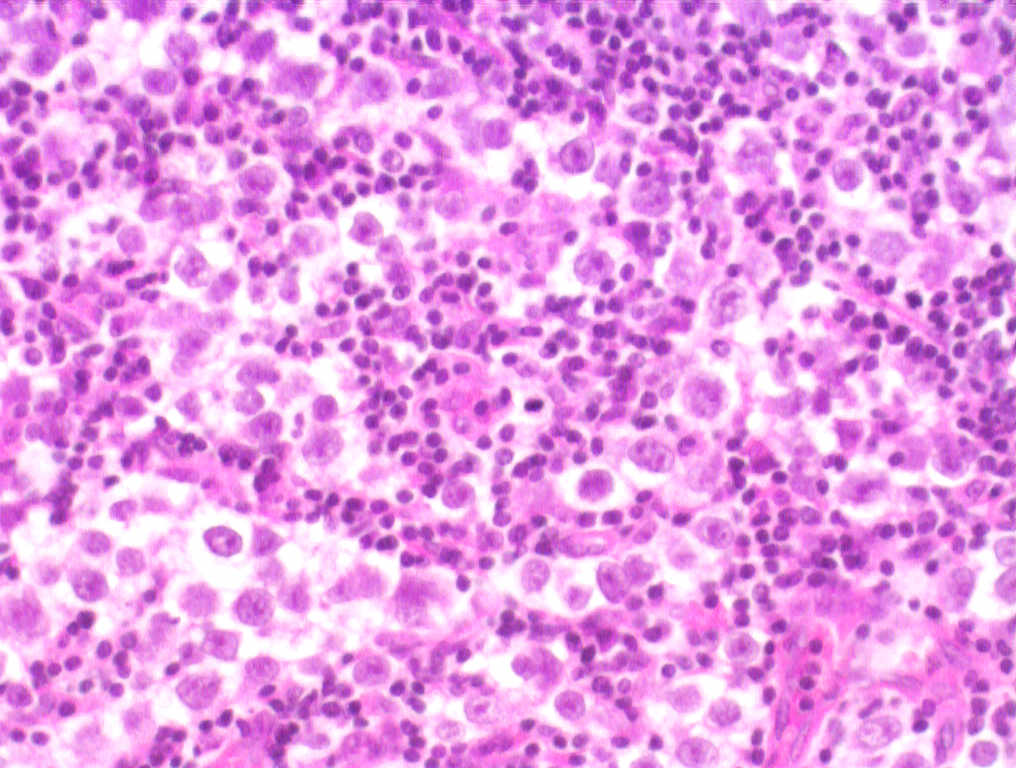Testis seminoma h amp e 200x