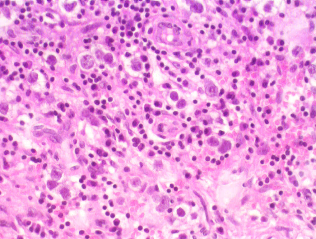 Testis seminoma h amp e 200x