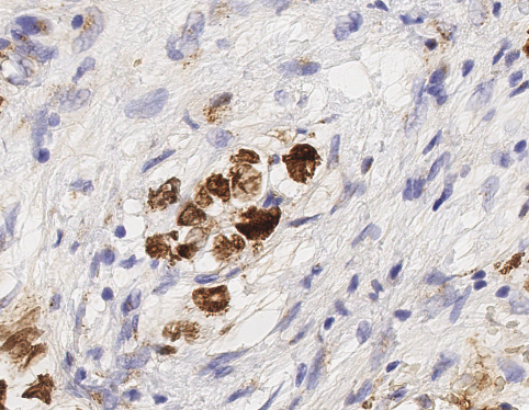 Cd117 c kit stain of mixed malignant germ cell tumor stainin