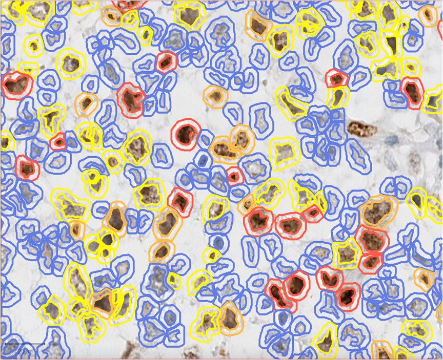 Ki67 calculation by qupath in a pure seminoma the colors rep