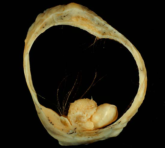 This is the same case presented in image mature cystic terat