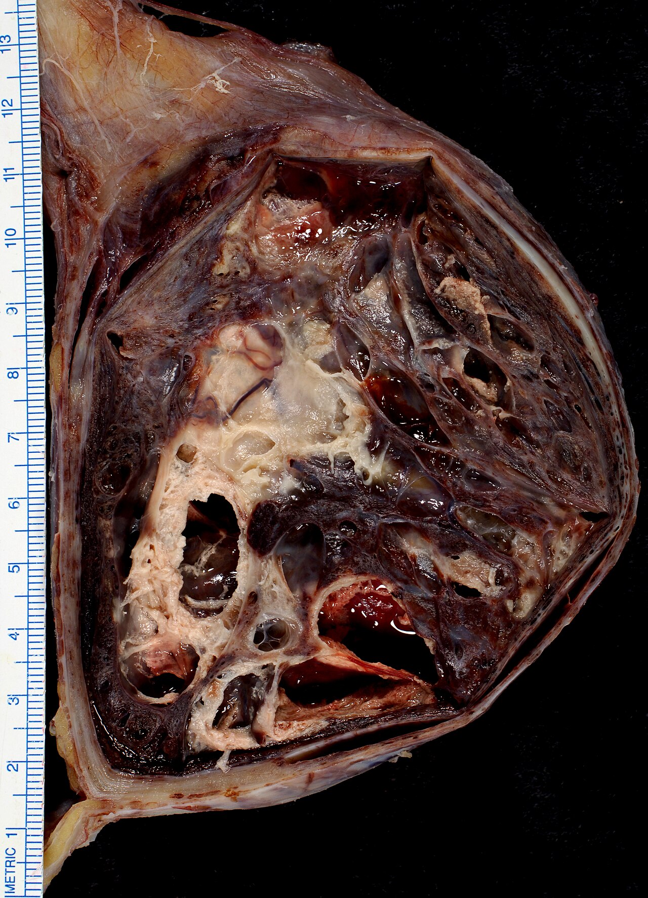 Mixed germ cell tumor of testis w ruler pathological and his