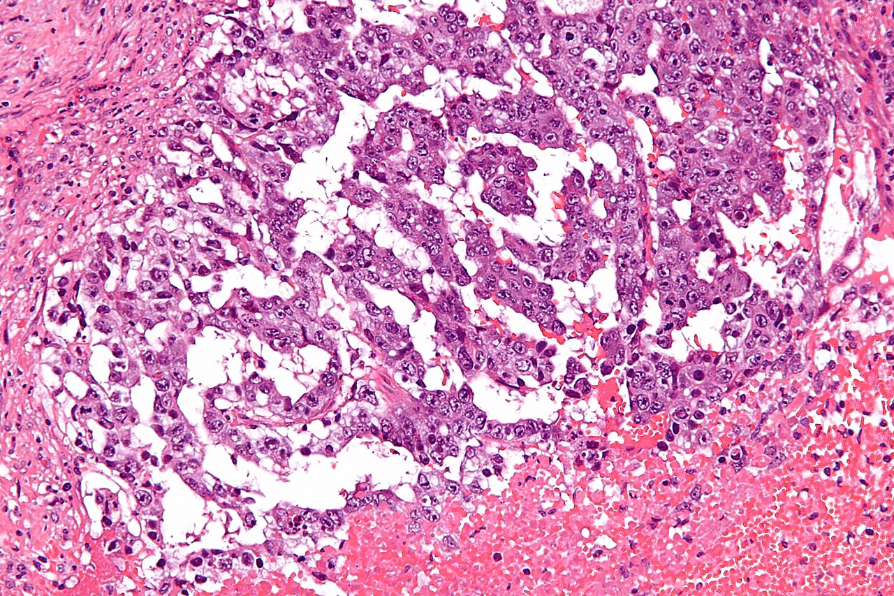 High magnification micrograph of a mixed germ cell tumour al