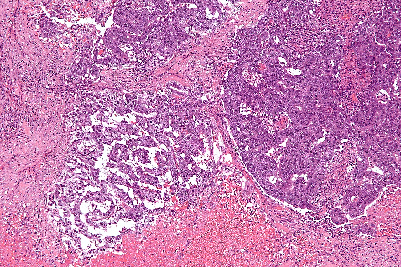 Intermediate magnification micrograph of a mixed germ cell t