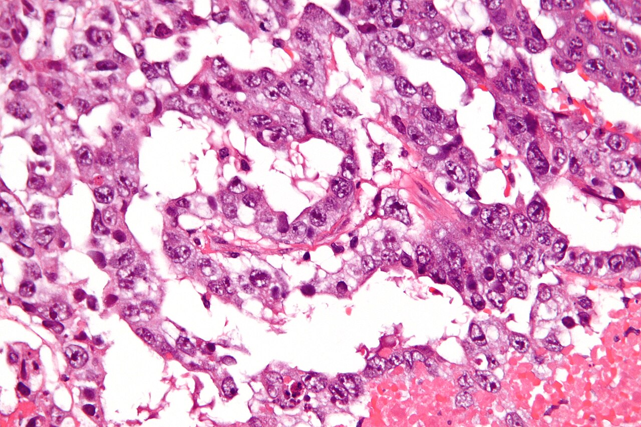 Very high magnification micrograph of a mixed germ cell tumo
