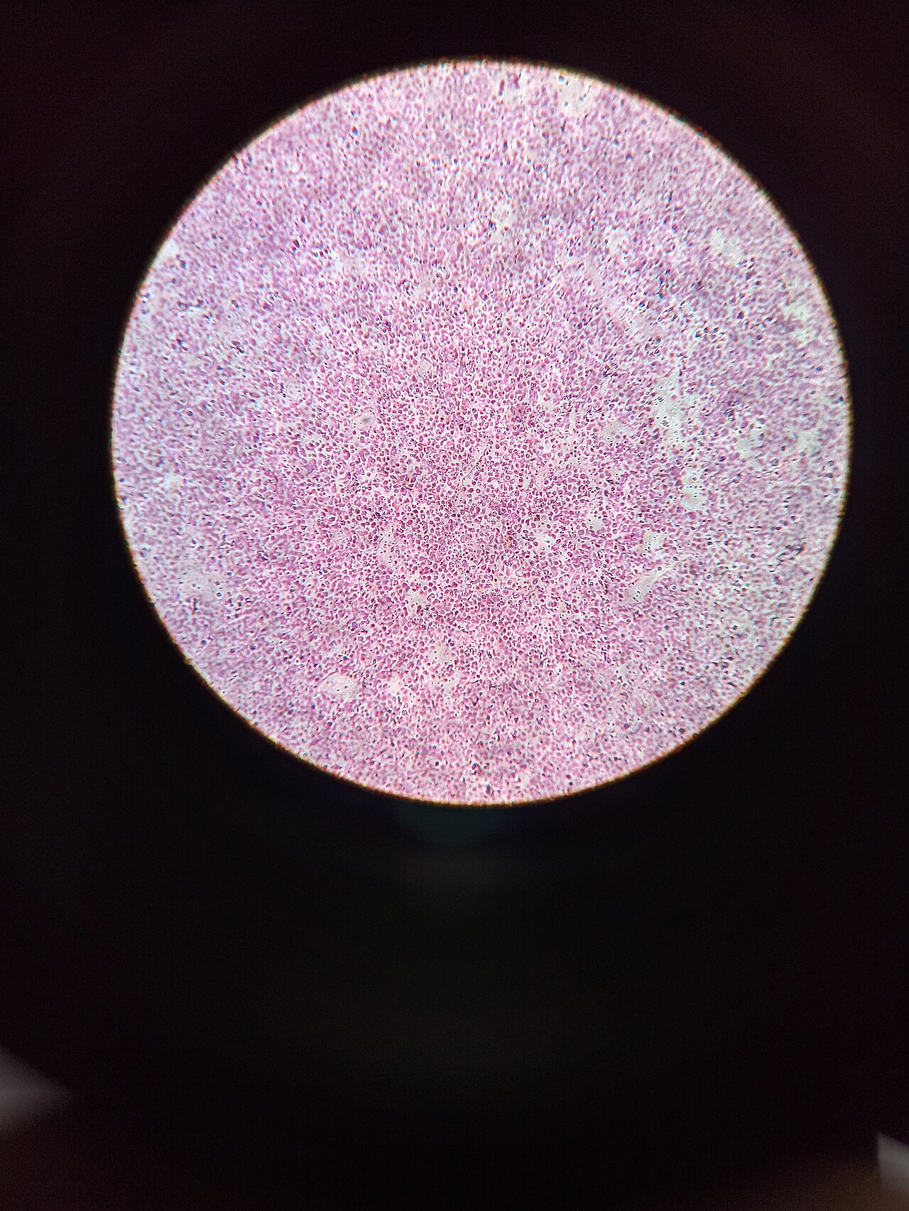 Most common germ cell tumor of testes