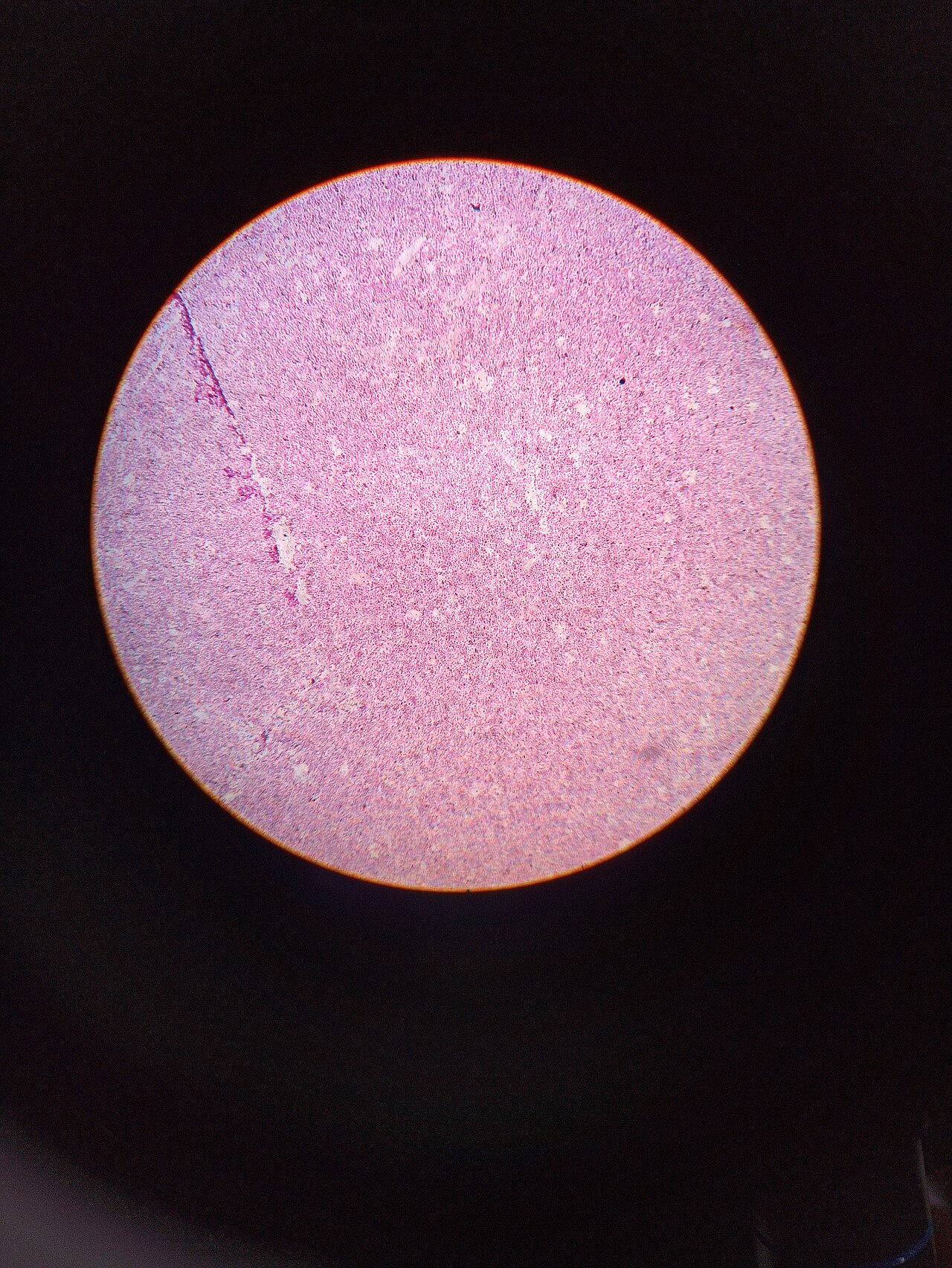 Most common germ cell tumor of testes