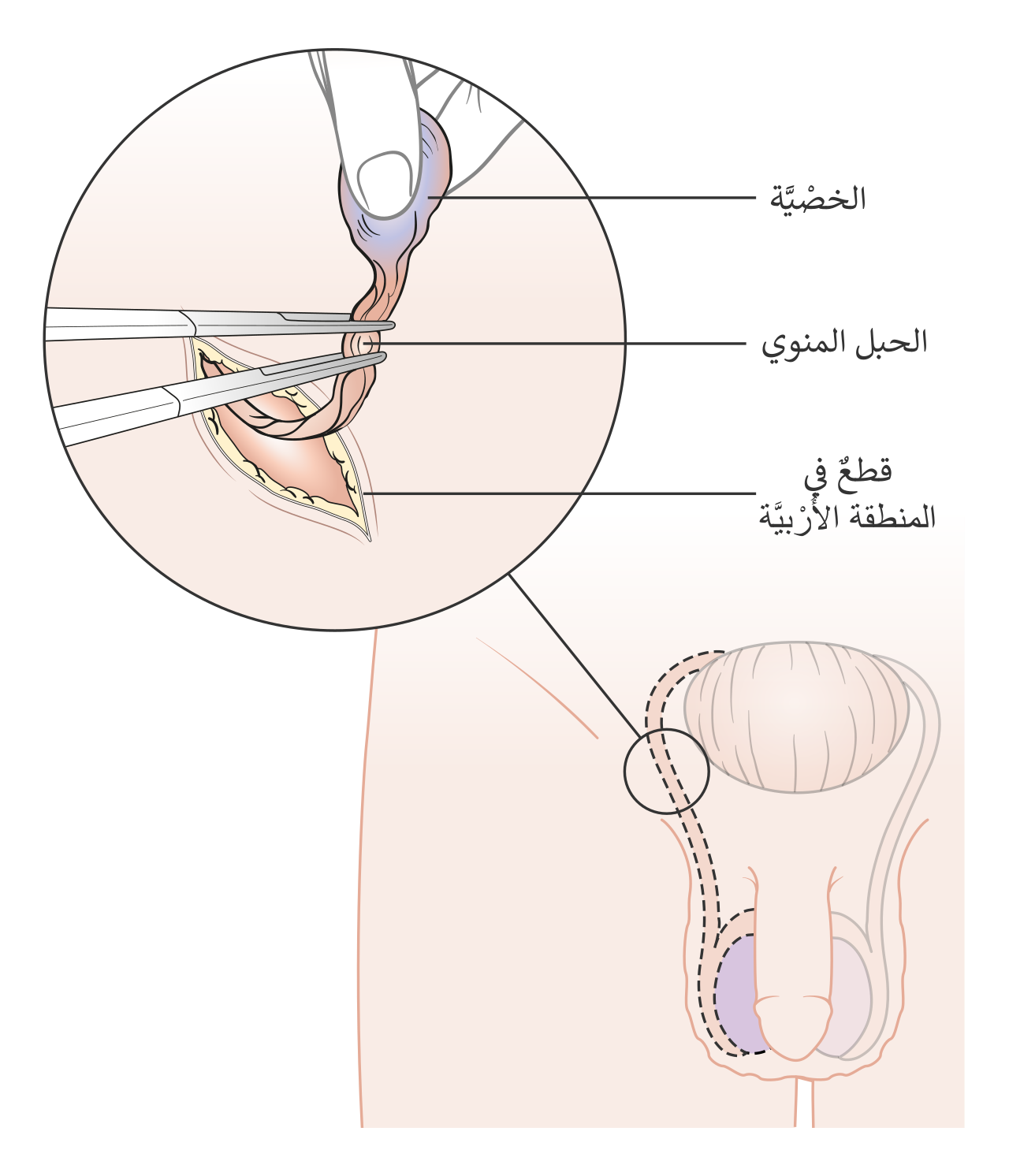 Diagram showing how the testicle is removed orchidectomy