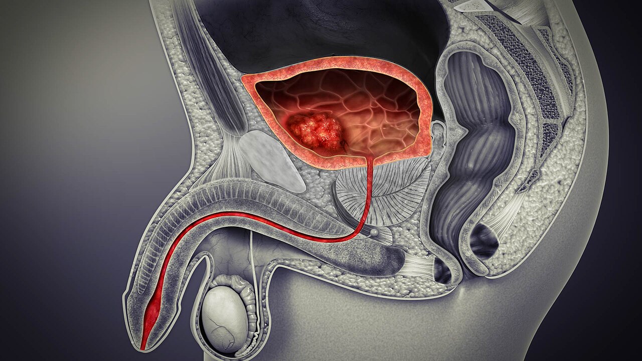 3d medical animation still showing urinary bladder cancer