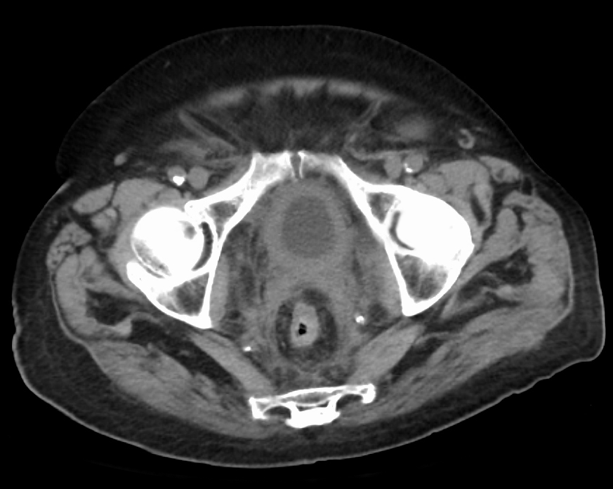 Bladder wall thickening due to cancer this is an edited vers
