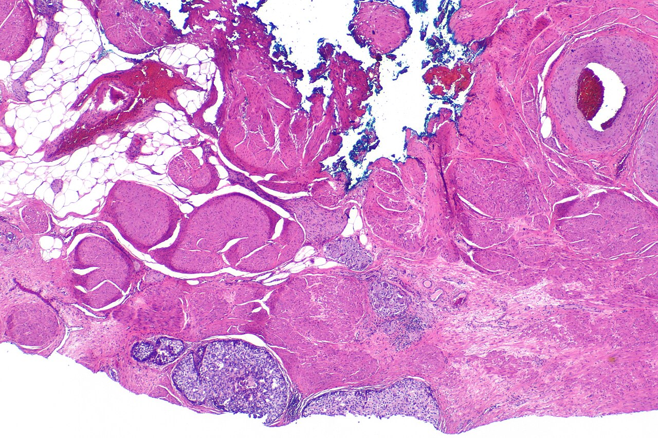 Micrograph showing invasion of the urinary bladder neck by p