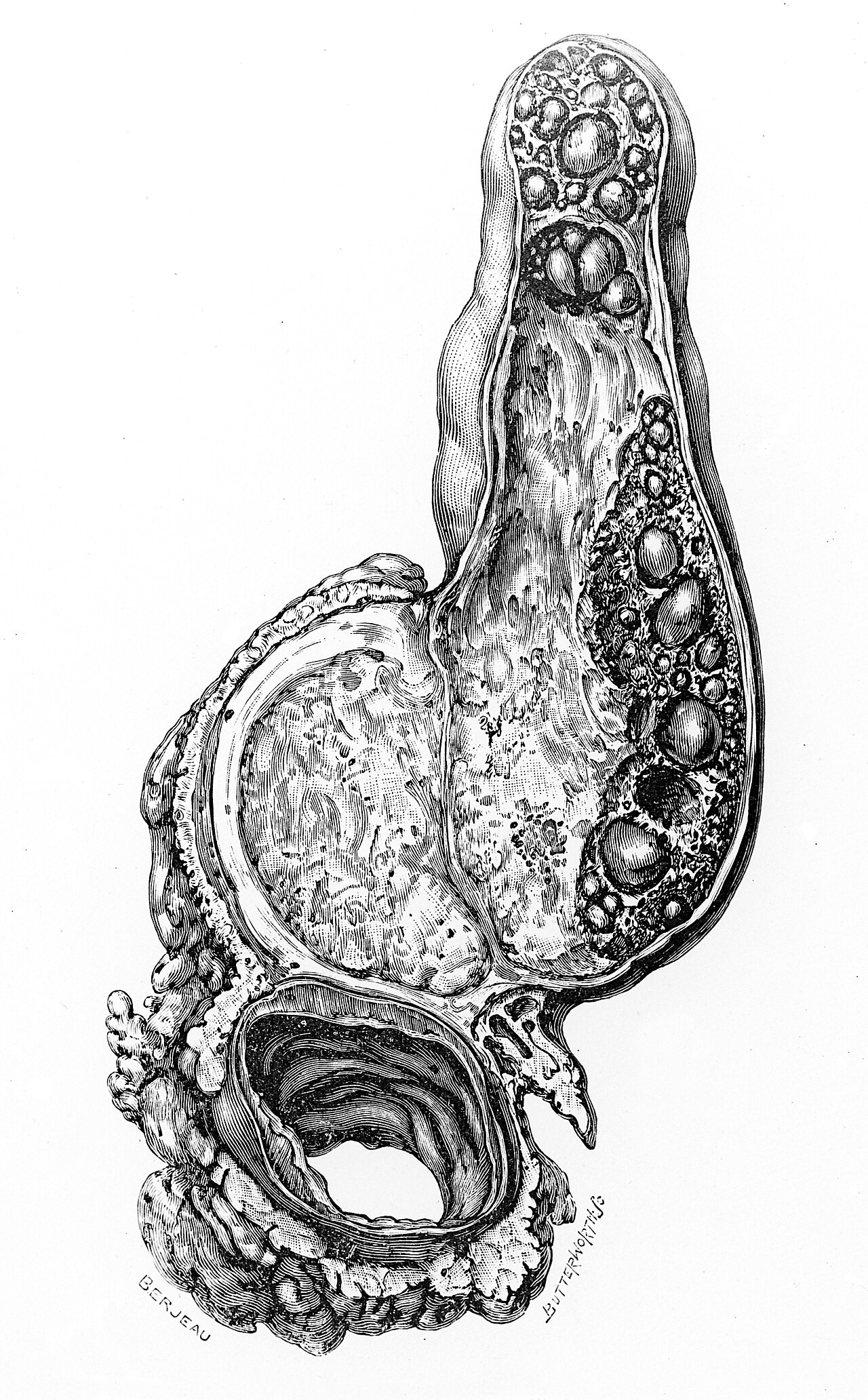 Cancer of the gall bladder wellcome images keywords neoplasm