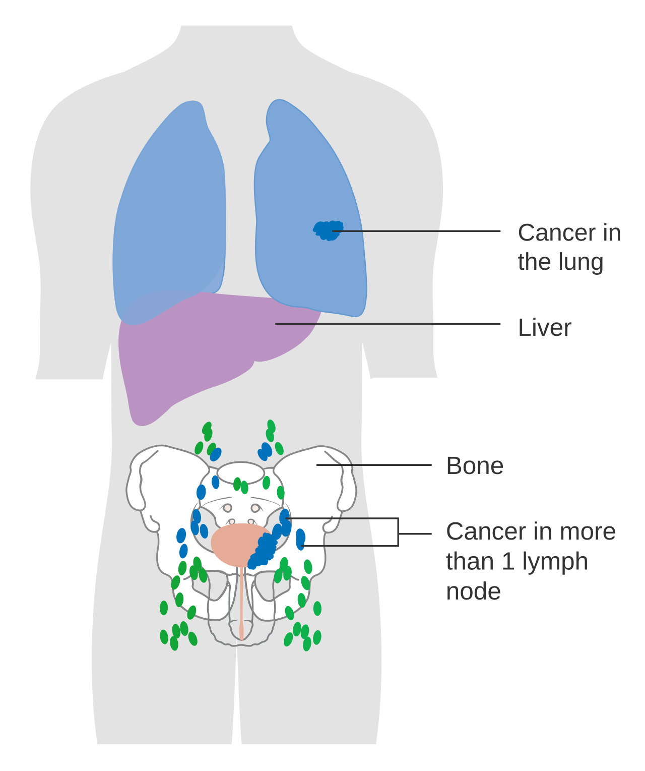 Diagram showing advanced bladder cancer