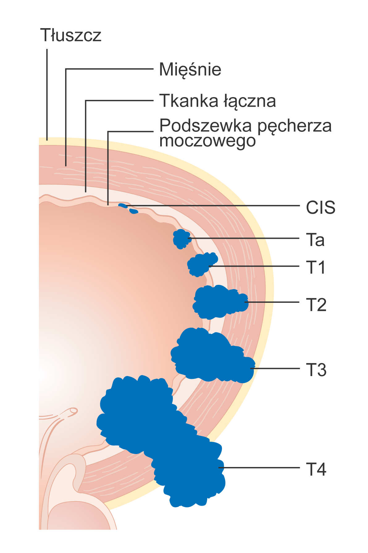 Schemat zaawansowania miejscowego raka p cherza moczowego