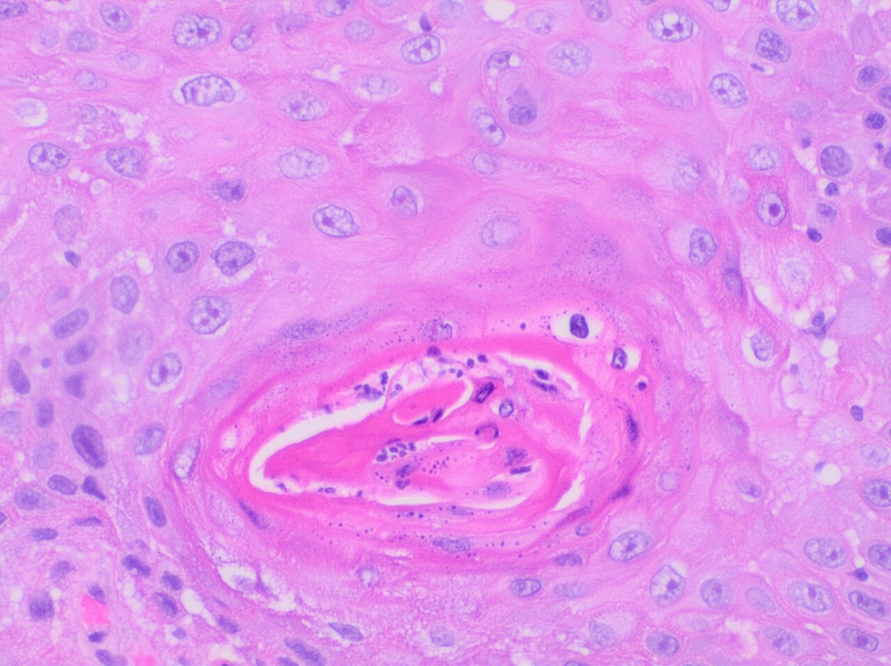 Histopathology of keratinizing squamous cell carcinoma of th